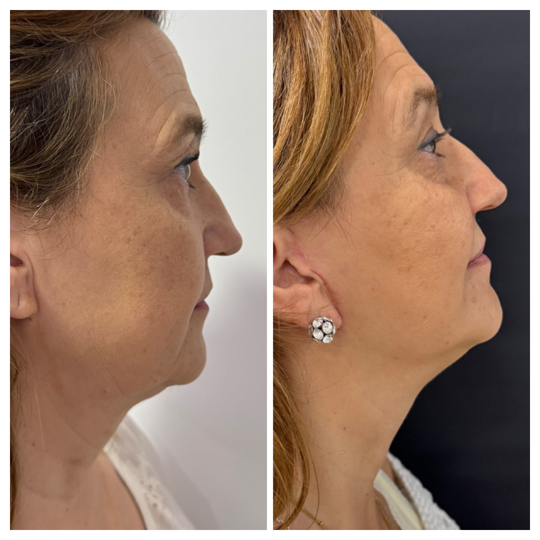 5_1